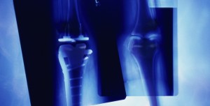 implantes óseos