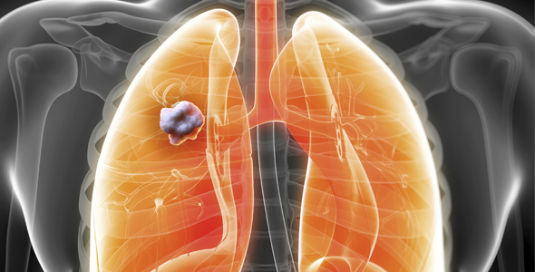 Descubren sistema para detectar cáncer pulmonar con un hemograma ...