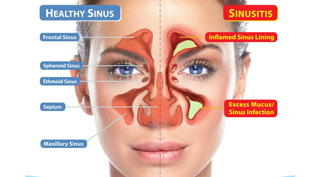Diferencias Entre Sntomas Del Coronavirus Y La Rinitis Diferencias Entre Sntomas Del Coronavirus Y La Rinitis