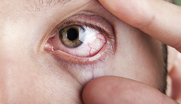5 consejos para cuidarte del síndrome del ojo seco