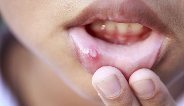 5 Remedios para curar de la boca | Revista VIDASANA